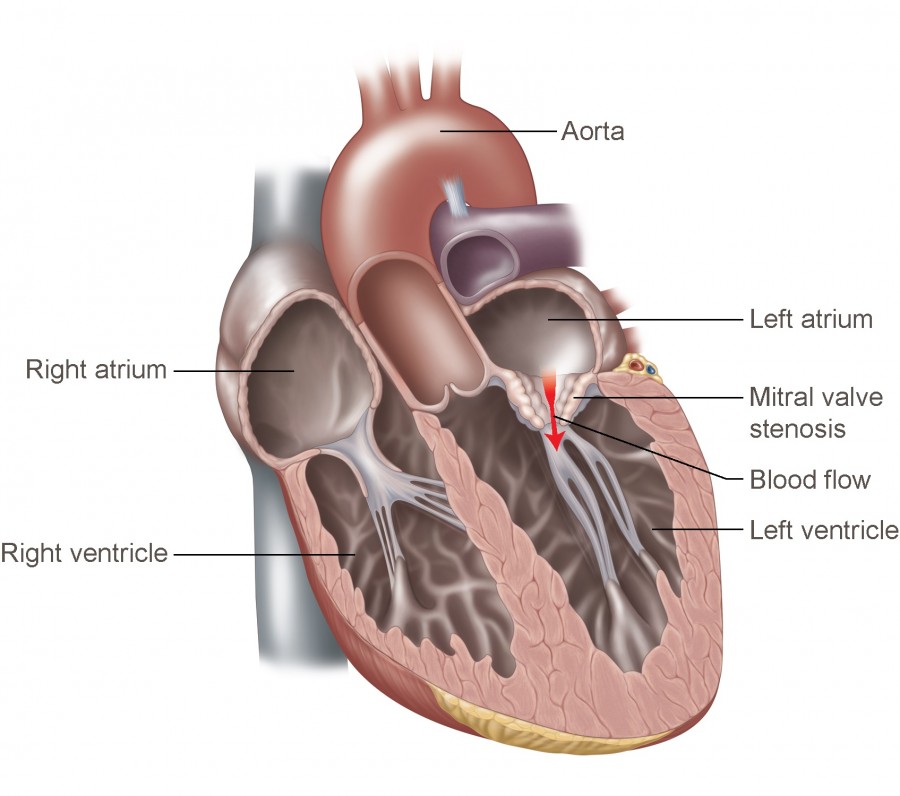 Mitral Valve Stenosis Temple Health